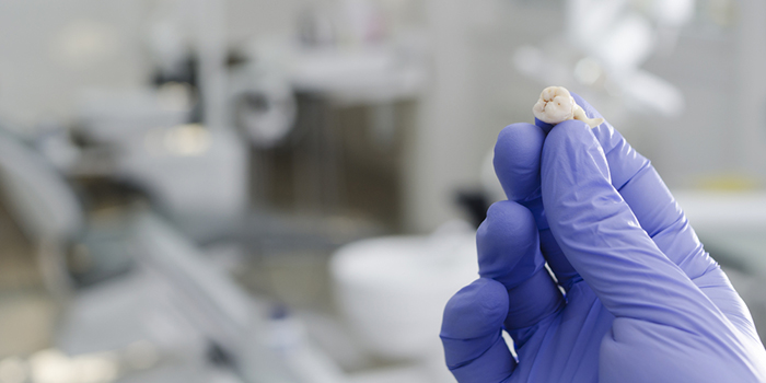 早めが肝心！　親知らずの処置を急ぐべき5つの理由