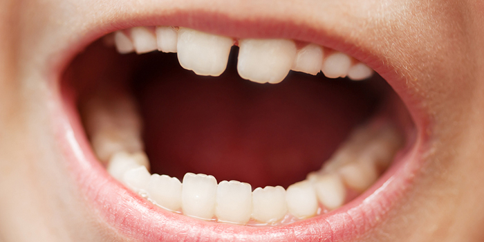 必見!歯並びに影響する悪習慣