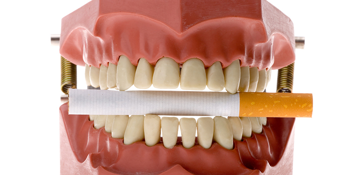 タバコの悪影響は口の中にも!喫煙と歯周病の関係とは