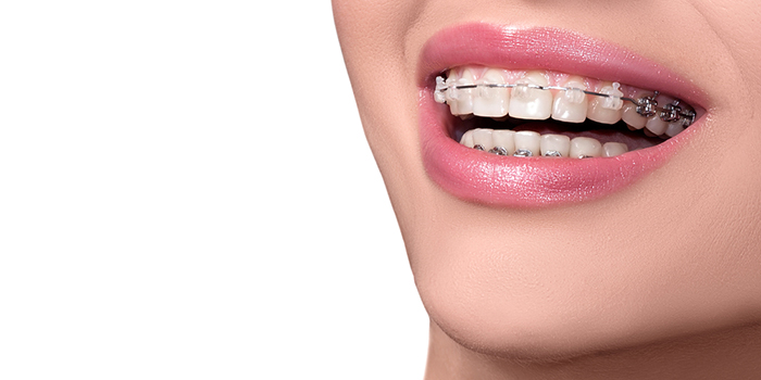 歯列矯正中でも気楽に食べられるメニューをご紹介!