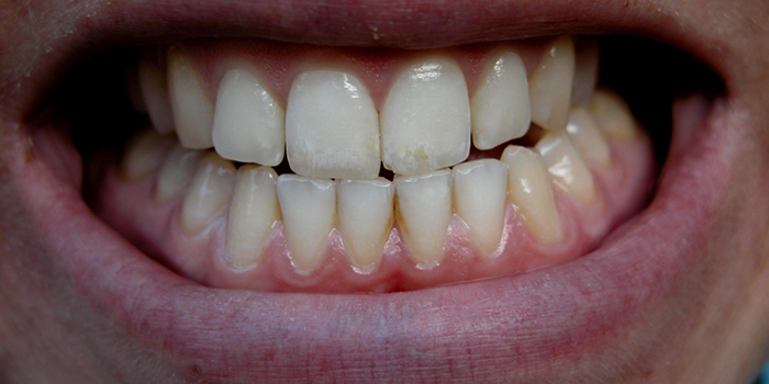 危険性が高い! 歯ぎしりなどの「咬合神経症」とは