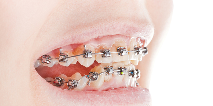 咬合神経症の原因・治療法