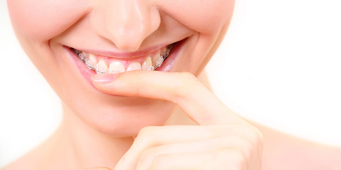 出っ歯について