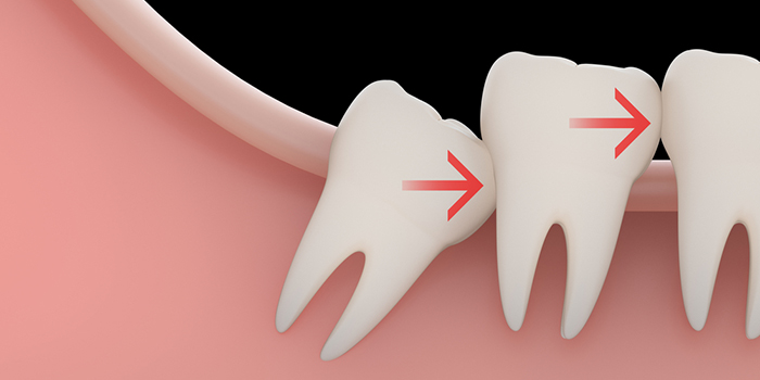 親知らずが歯並びに悪影響を与える？