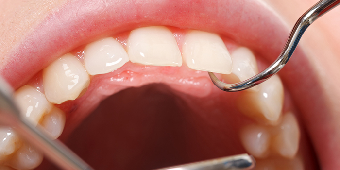 出っ歯は健康に悪影響を及ぼす!?