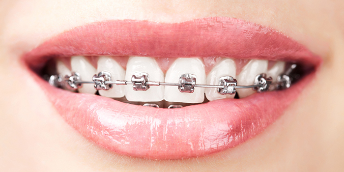 受け口の治療法は?