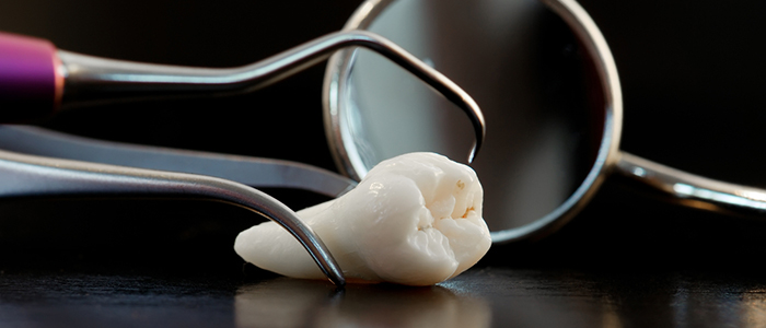 歯列矯正に抜歯は必須!? 抜歯の本数を決める要素とは?