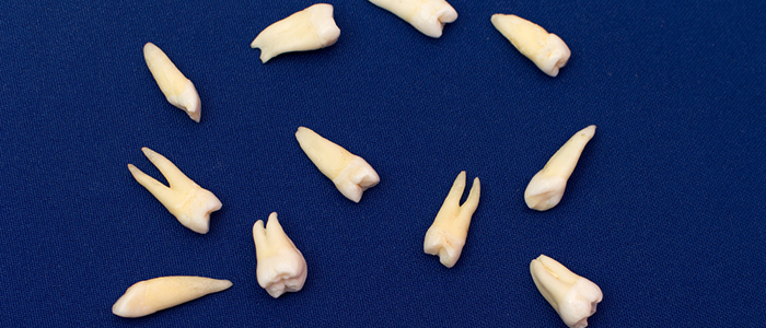 歯列矯正で抜歯をする歯を選択する基準