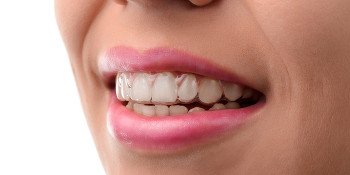 意外にたくさんあった、マウスピース矯正の種類