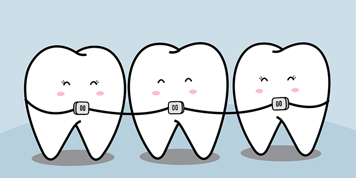歯を抜かない矯正「ミュー」とはどんな治療法? そのメリットとは?