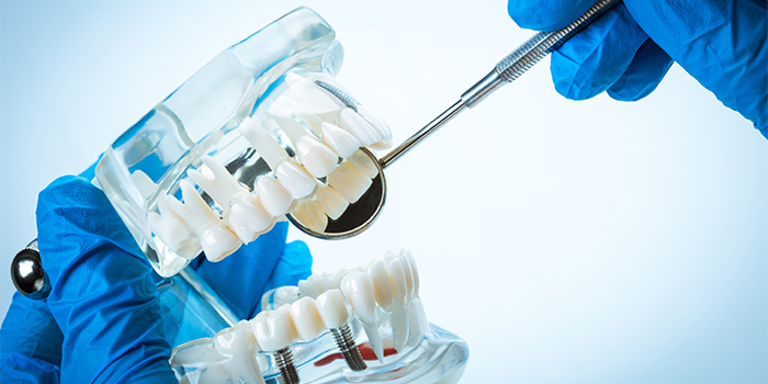 歯の詰め物が取れる原因と取れた後にしてはいけないこと