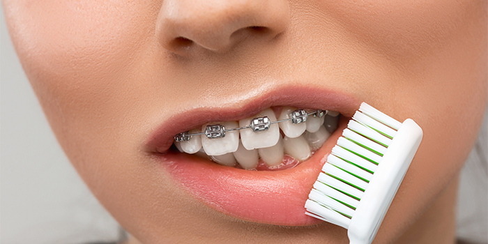 ブラケット(矯正装置)を装着している時の正しい歯磨きやケアとは?