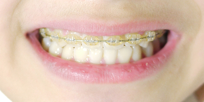 ブラケット(矯正装置)を装着している時の正しい歯磨きやケアとは?