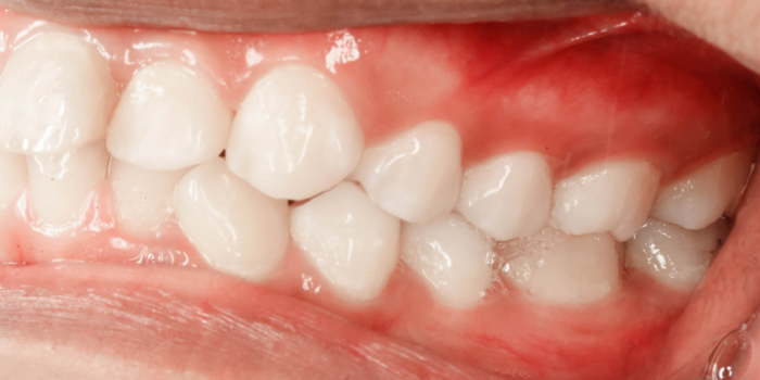 インビザラインのデメリットは?