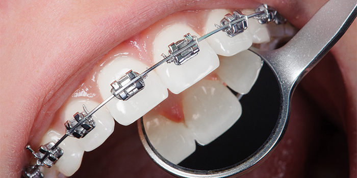 「歯を抜かない歯列矯正」その特徴と治療法、注意点とは?