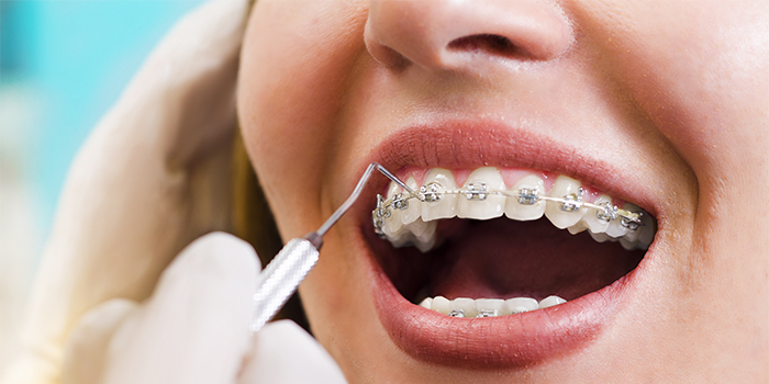 「歯を抜かない歯列矯正」その特徴と治療法、注意点とは?