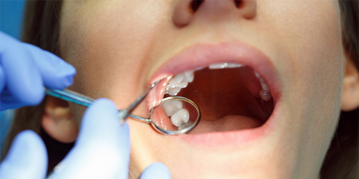 「歯を抜かない歯列矯正」その特徴と治療法、注意点とは?