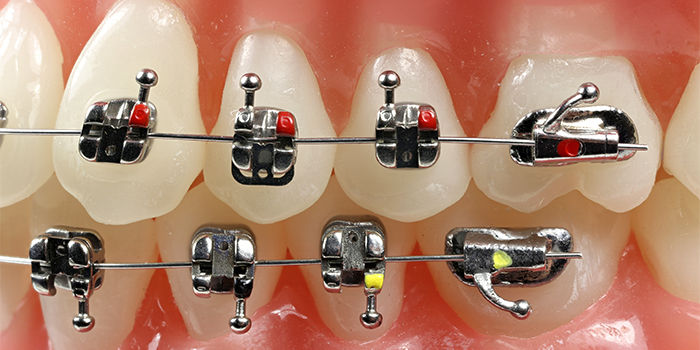 「歯を抜かない歯列矯正」その特徴と治療法、注意点とは?