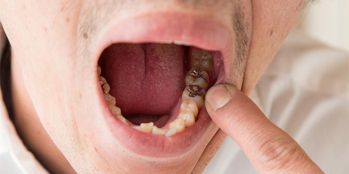 前歯の歯並びの悪さが気になる……見た目を損ねない矯正治療とは?