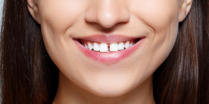 前歯の歯並びの悪さが気になる……見た目を損ねない矯正治療とは?