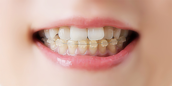前歯の歯並びの悪さが気になる……見た目を損ねない矯正治療とは?