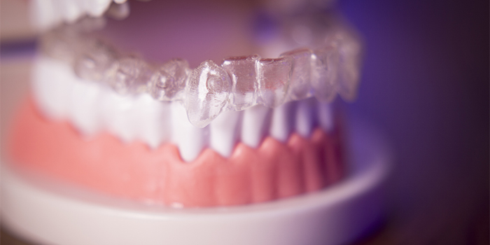 「歯列矯正」と「差し歯」歯並びを治すならどっちが良いの?