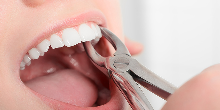 「歯列矯正」と「差し歯」歯並びを治すならどっちが良いの?