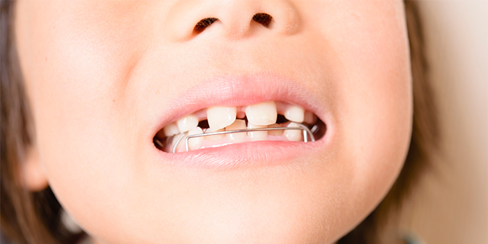 矯正で抜歯は必要? 歯列矯正治療で歯を抜くリスクと「抜かない治療」