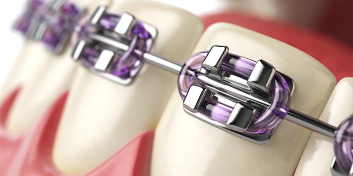 矯正で抜歯は必要? 歯列矯正治療で歯を抜くリスクと「抜かない治療」