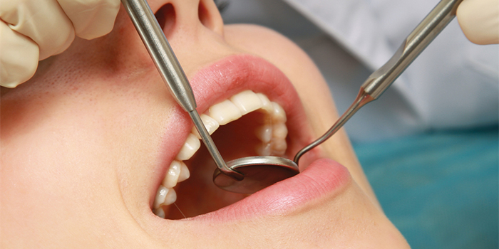 親知らず治療で覚えておきたい「ドライソケット」の原因と対処法とは?