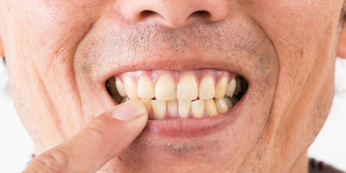 歯の着色はどうして起こる? その原因と対処法