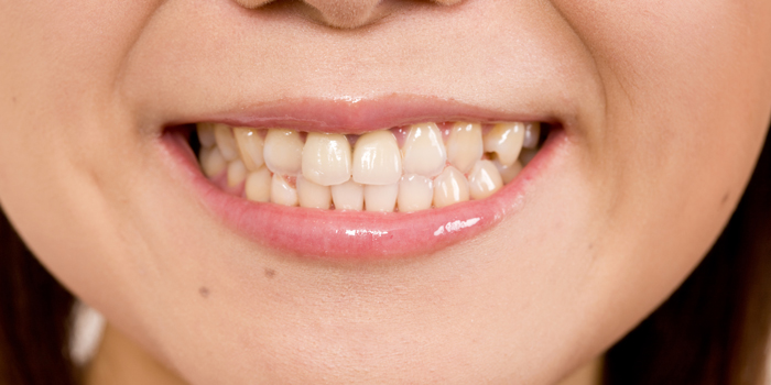 叢生(そうせい)