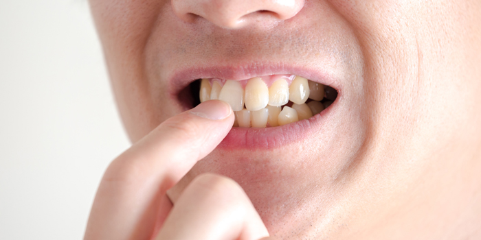 上顎前突(じょうがくぜんとつ)