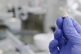 早めが肝心！　親知らずの処置を急ぐべき5つの理由