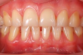 口元に大きな悪影響！ガミースマイルの原因と治療法