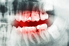 虫歯を放置するとどうなるの？ 虫歯を治療すべき絶対的な理由とは