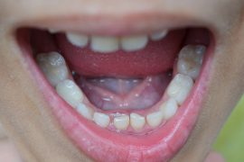 噛み合わせが悪くなる原因＆健康への悪影響とは