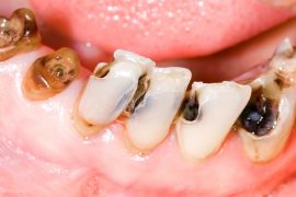 徐々に進む虫歯の恐怖!虫歯の進行段階と症状