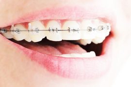 全顎矯正とどこが違う？　部分矯正のメリットと注意点