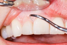 歯並びを悪化させる歯周病は糖尿病との相関性がある！？