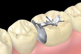 歯の詰め物が取れる原因と取れた後にしてはいけないこと