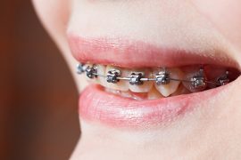 クレンチング症候群は歯と顎に悪影響を及ぼす！ その症状と原因とは